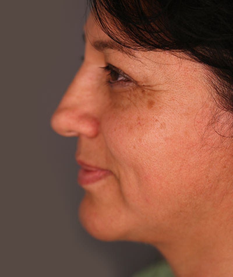 Facelift Before & After Gallery - Patient 108403891 - Image 4