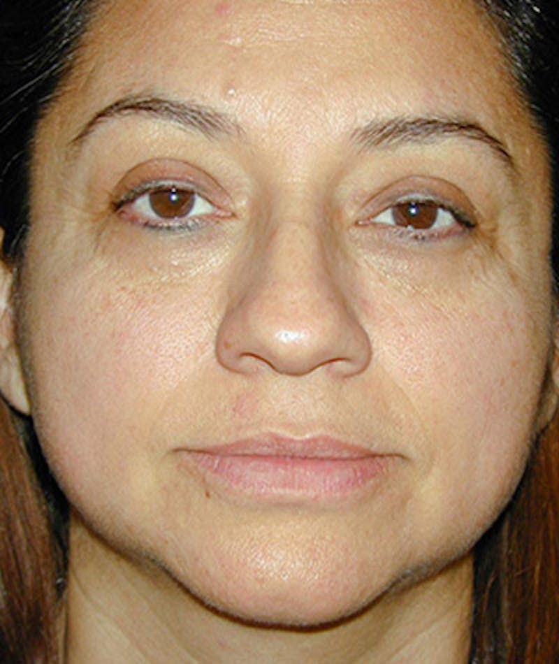 Facelift Before & After Gallery - Patient 108403891 - Image 1