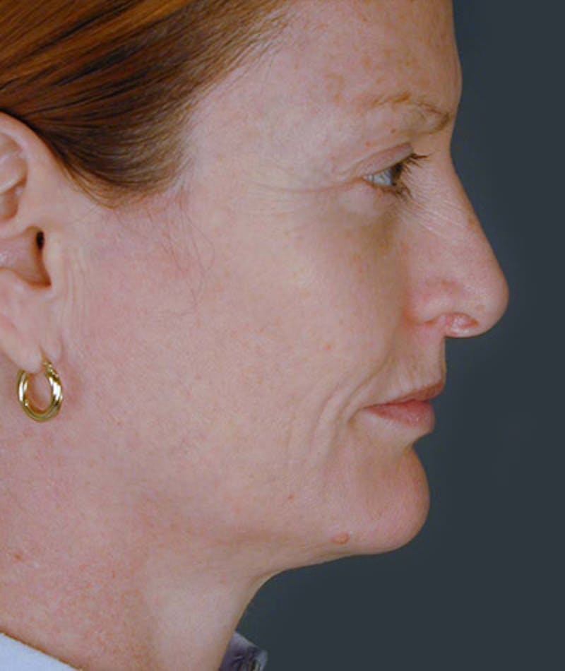 Facelift Before & After Gallery - Patient 108403930 - Image 3