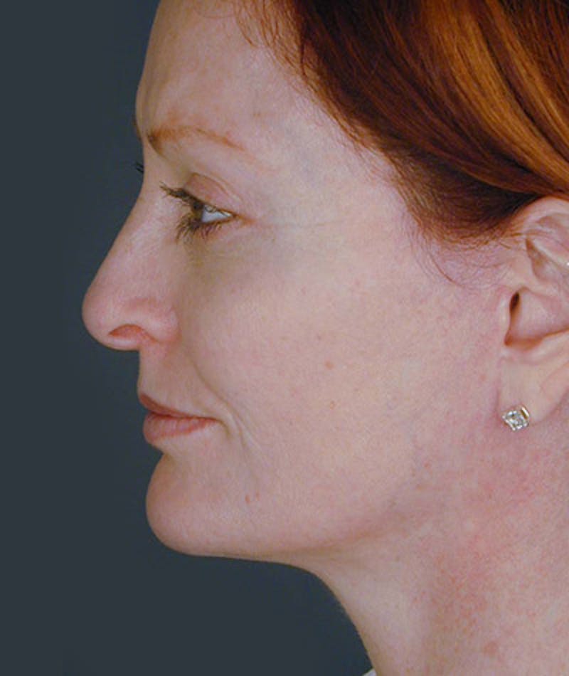 Facelift Before & After Gallery - Patient 108403930 - Image 4