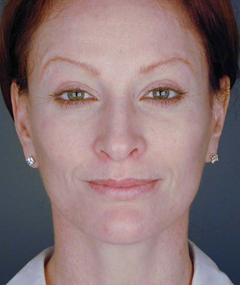 Facelift Before & After Gallery - Patient 108403930 - Image 6