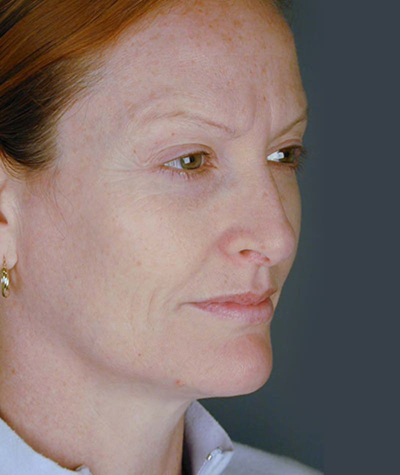 Facelift Before & After Gallery - Patient 108403930 - Image 1
