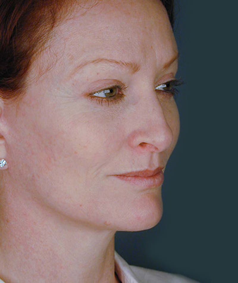 Facelift Before & After Gallery - Patient 108403930 - Image 2