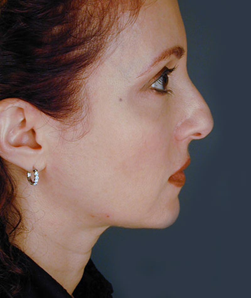 Facelift Before & After Gallery - Patient 108403950 - Image 3