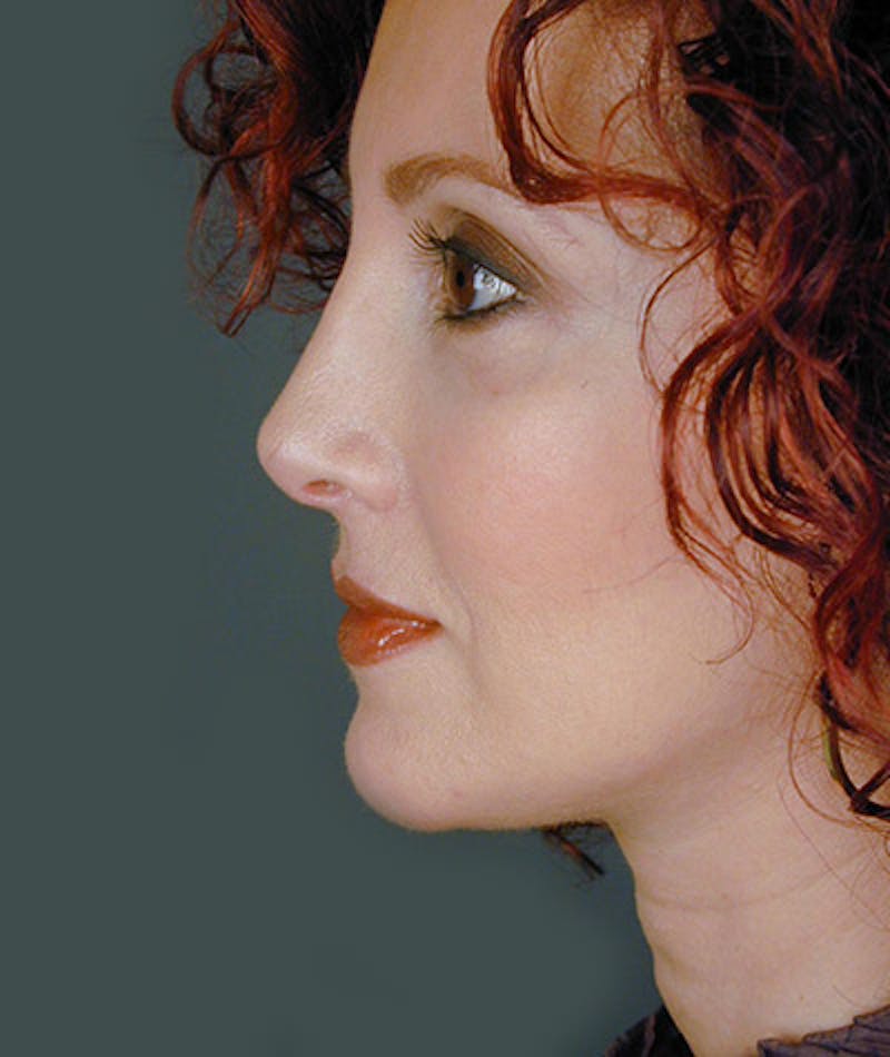 Facelift Before & After Gallery - Patient 108403950 - Image 4