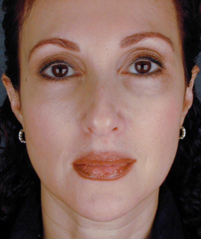 Facelift Before & After Gallery - Patient 108403950 - Image 5