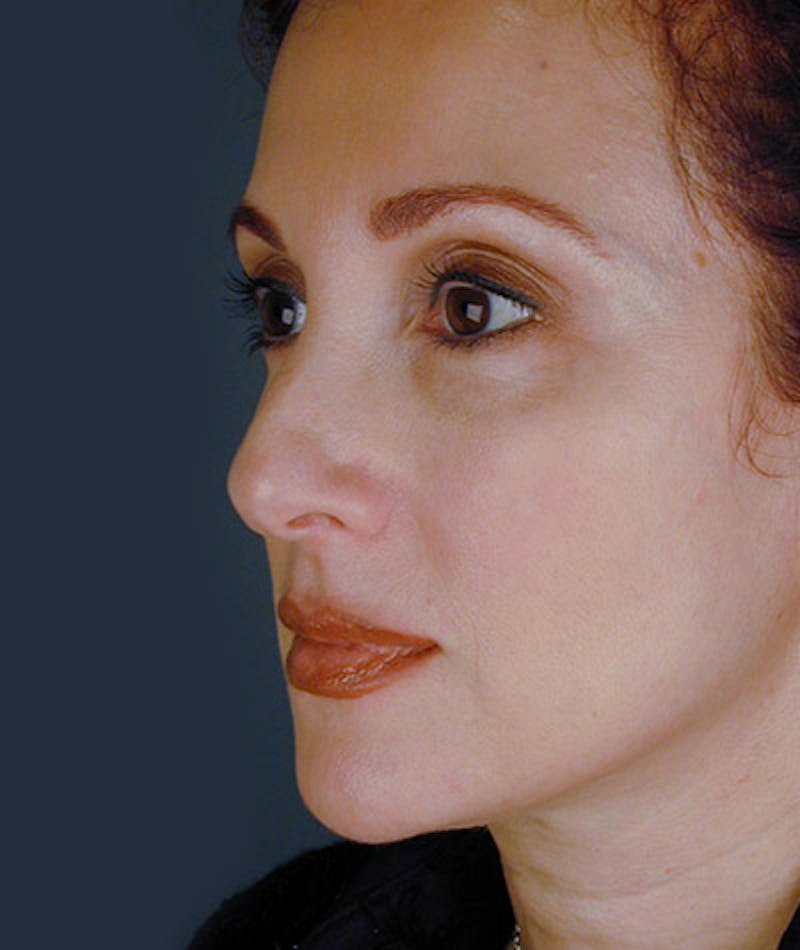 Facelift Before & After Gallery - Patient 108403950 - Image 1