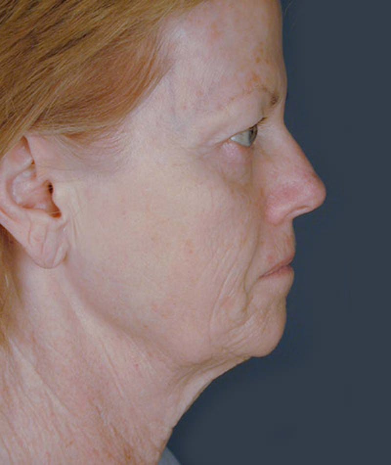 Facelift Before & After Gallery - Patient 108403976 - Image 3