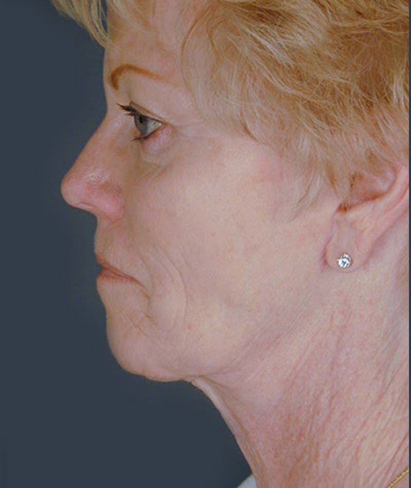 Facelift Before & After Gallery - Patient 108403976 - Image 4