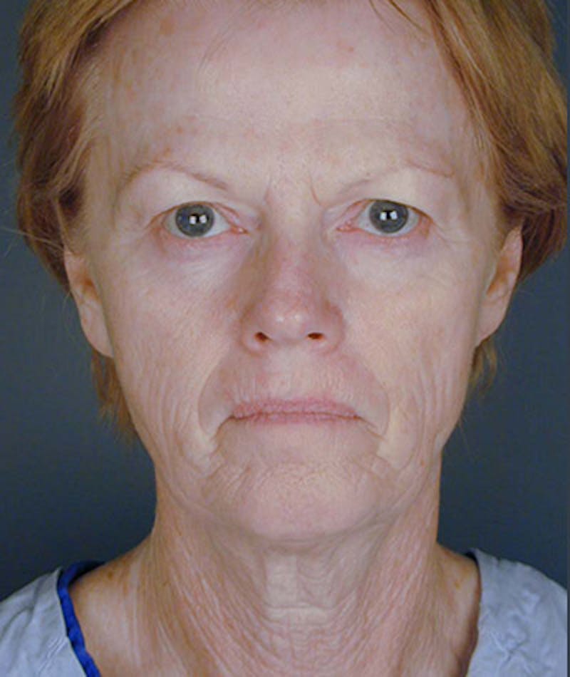 Facelift Before & After Gallery - Patient 108403976 - Image 5