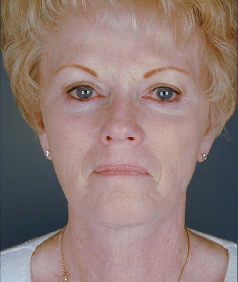 Facelift Before & After Gallery - Patient 108403976 - Image 6
