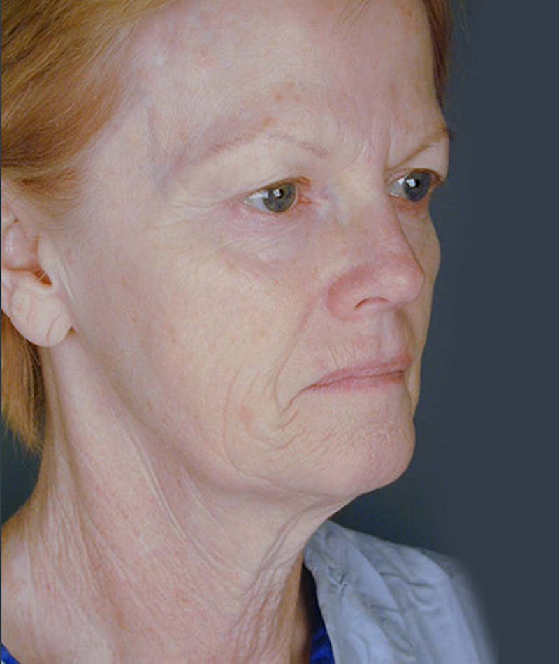 Facelift Before & After Gallery - Patient 108403976 - Image 1