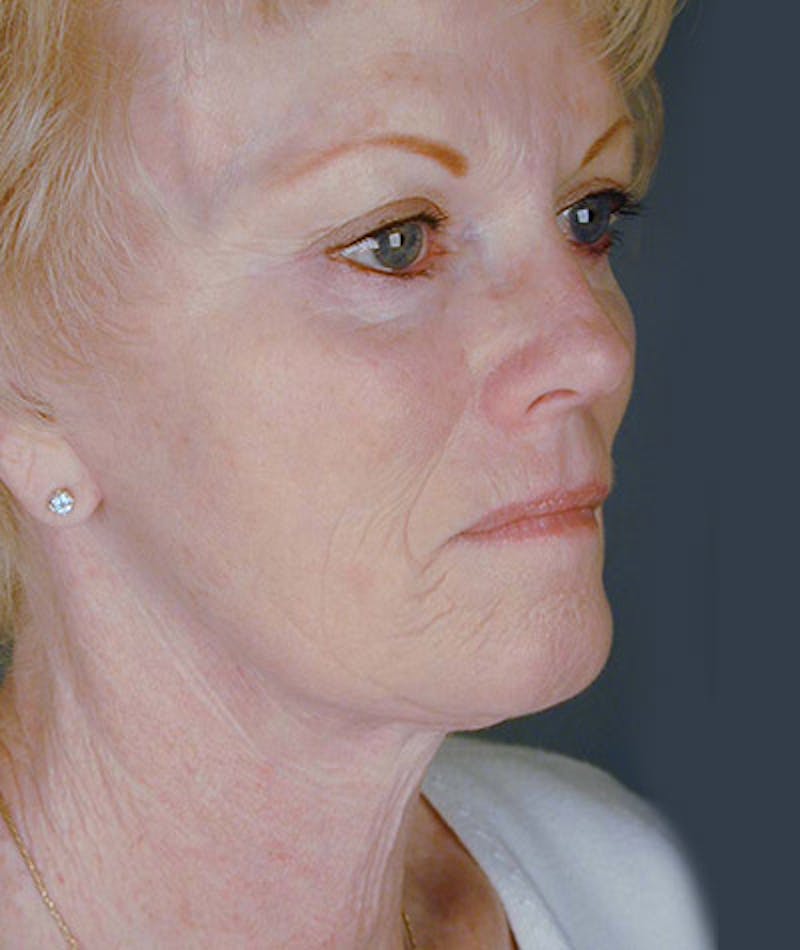Facelift Before & After Gallery - Patient 108403976 - Image 2