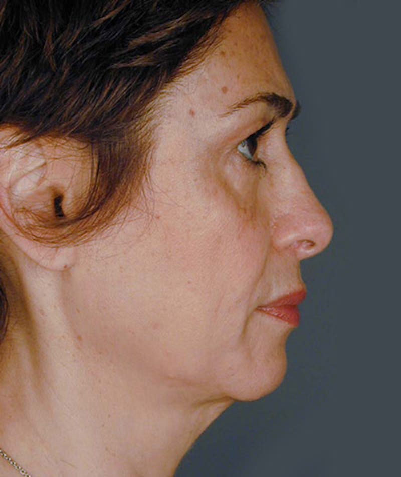 Facelift Before & After Gallery - Patient 108404000 - Image 1