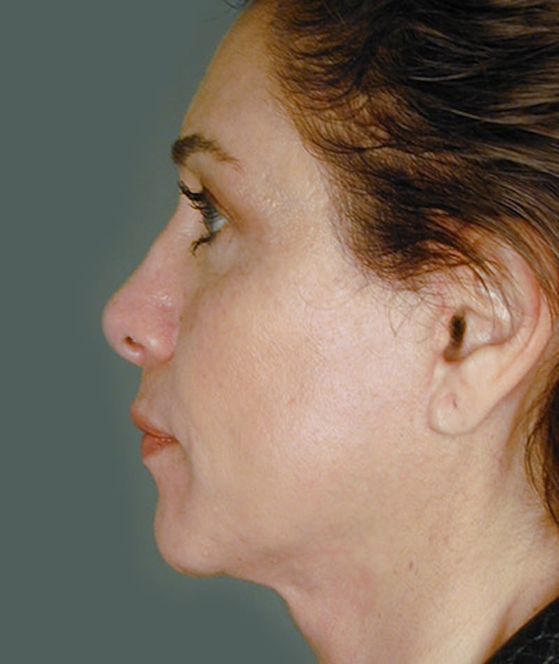 Facelift Before & After Gallery - Patient 108404000 - Image 4