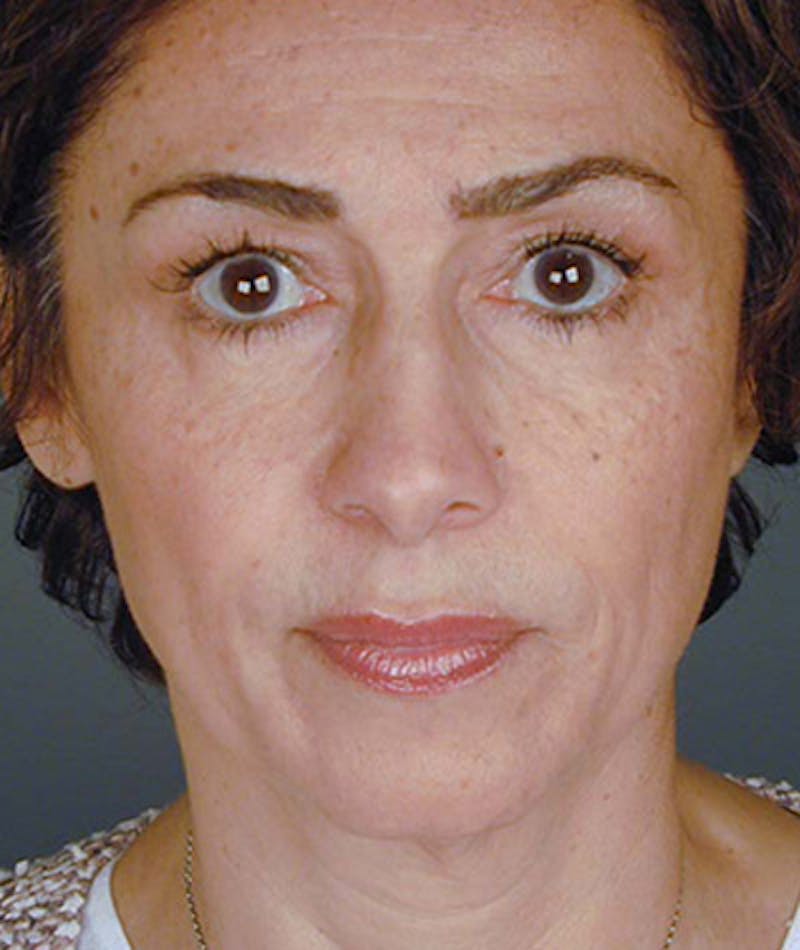 Facelift Before & After Gallery - Patient 108404000 - Image 3