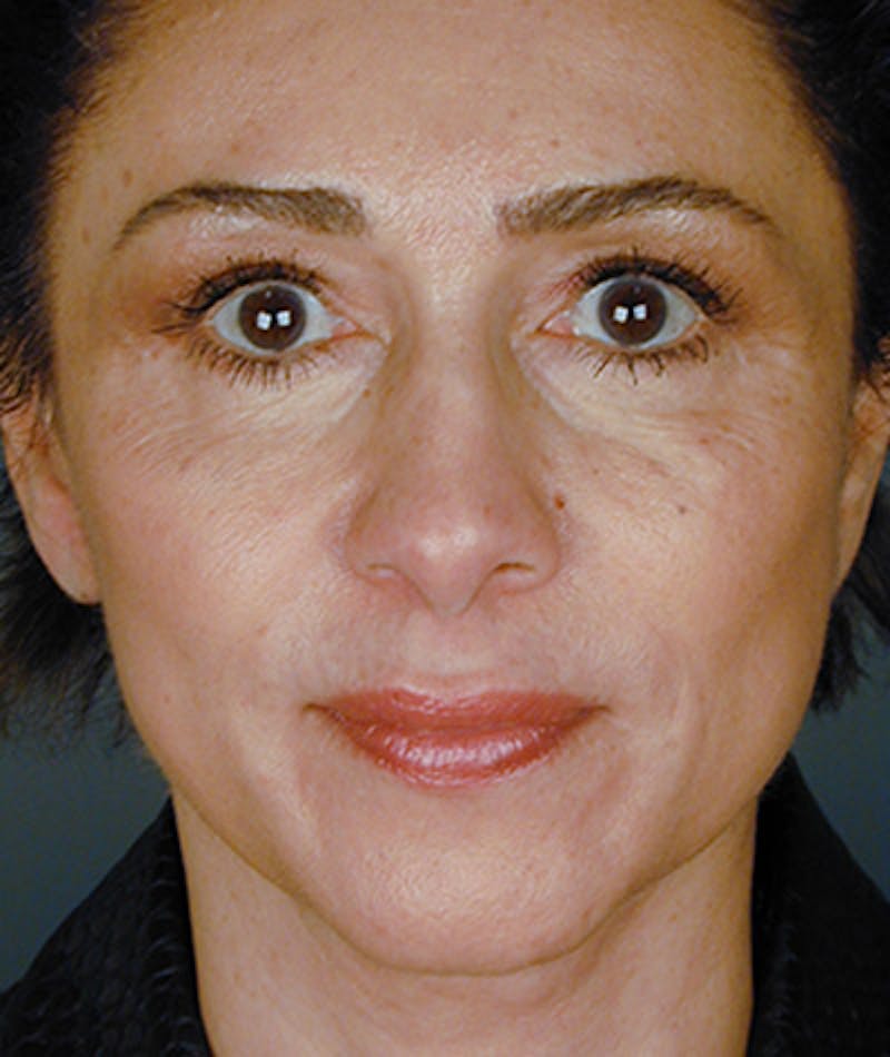 Facelift Before & After Gallery - Patient 108404000 - Image 6
