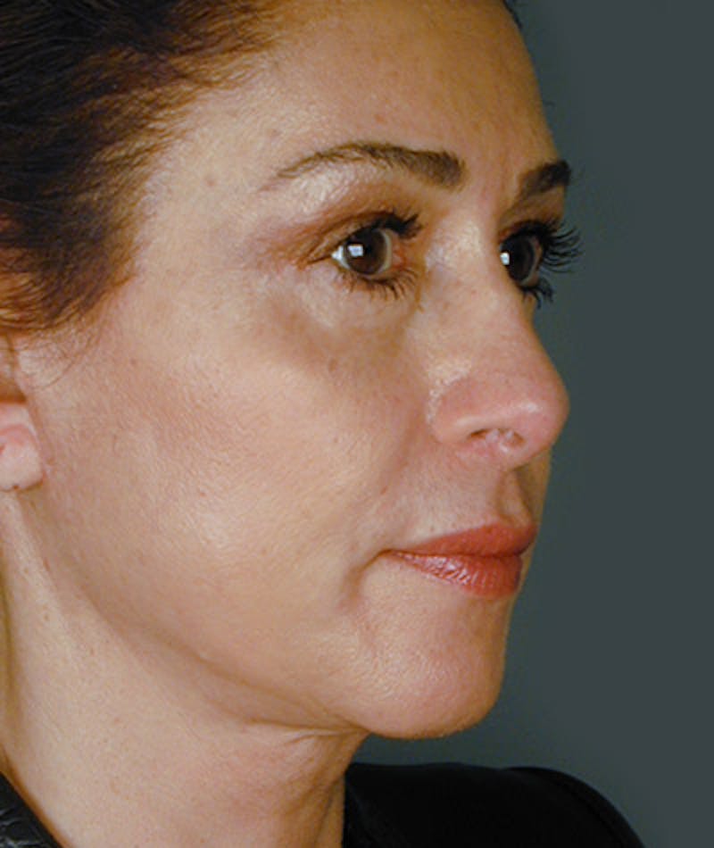 Facelift Before & After Gallery - Patient 108404000 - Image 2