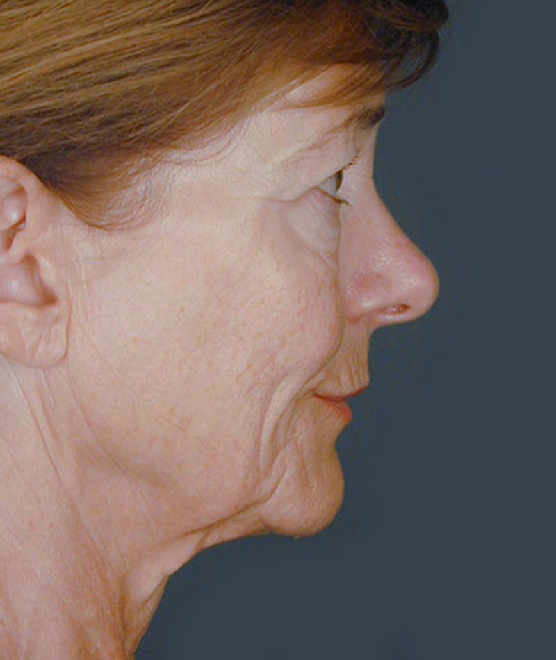 Facelift Before & After Gallery - Patient 108404068 - Image 3