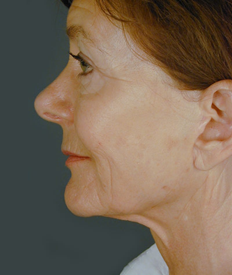 Facelift Before & After Gallery - Patient 108404068 - Image 2