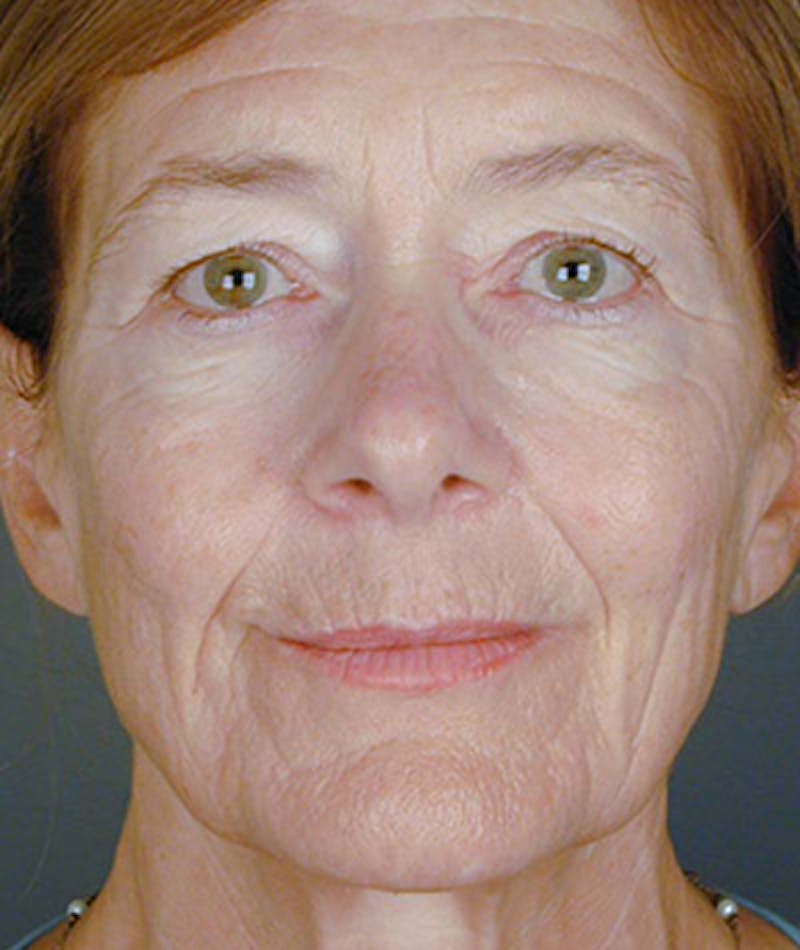 Facelift Before & After Gallery - Patient 108404068 - Image 5