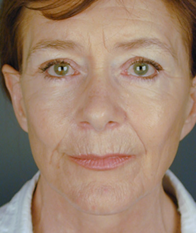 Facelift Before & After Gallery - Patient 108404068 - Image 6