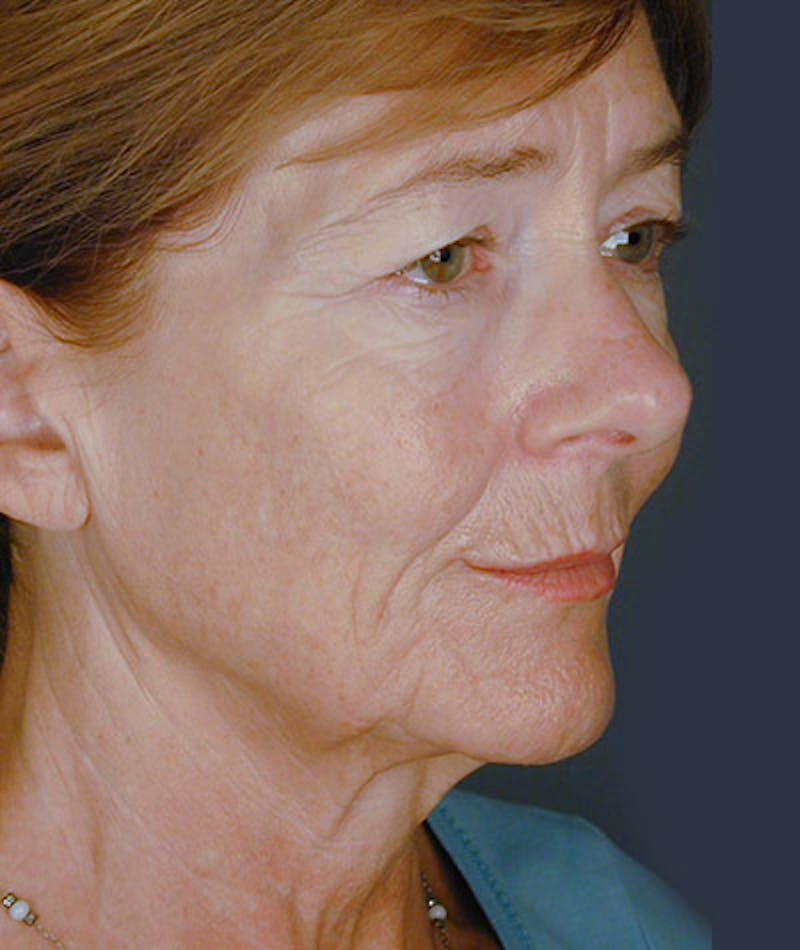 Facelift Before & After Gallery - Patient 108404068 - Image 1