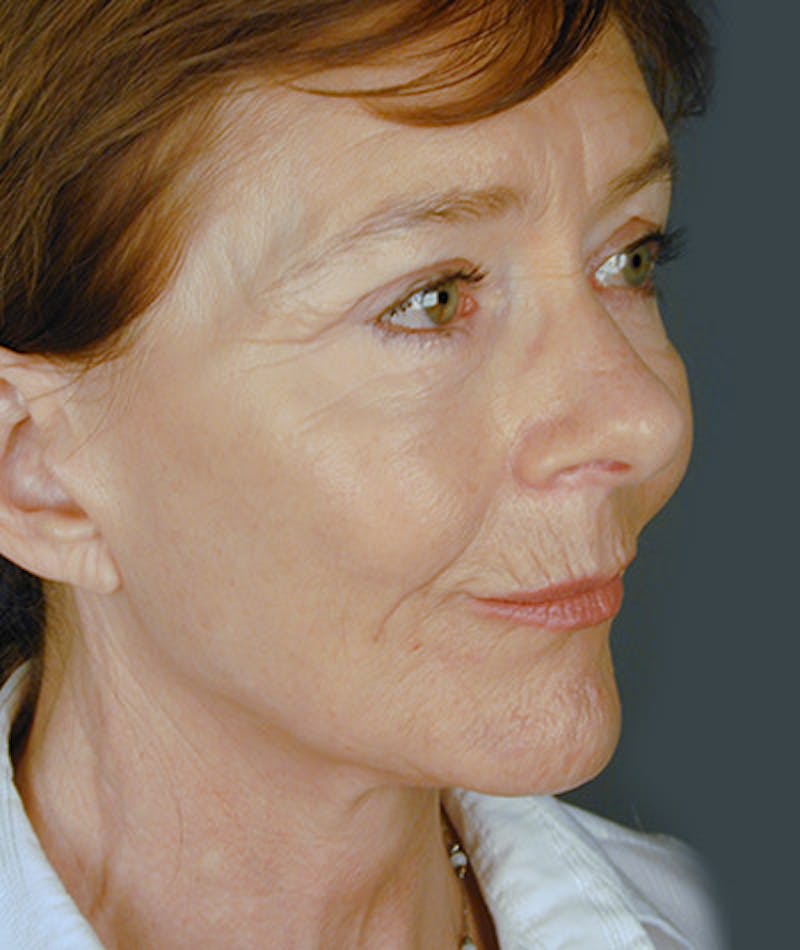 Facelift Before & After Gallery - Patient 108404068 - Image 2