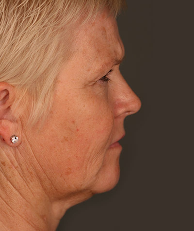 Facelift Before & After Gallery - Patient 108404111 - Image 3