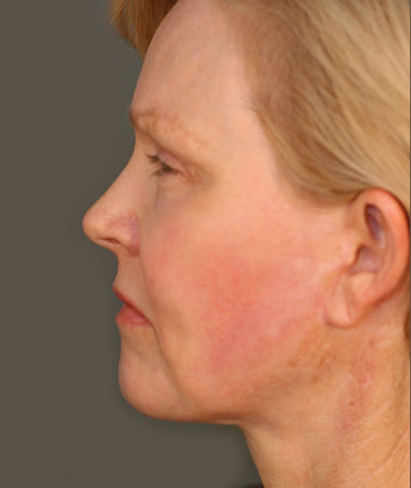 Facelift Before & After Gallery - Patient 108404111 - Image 4