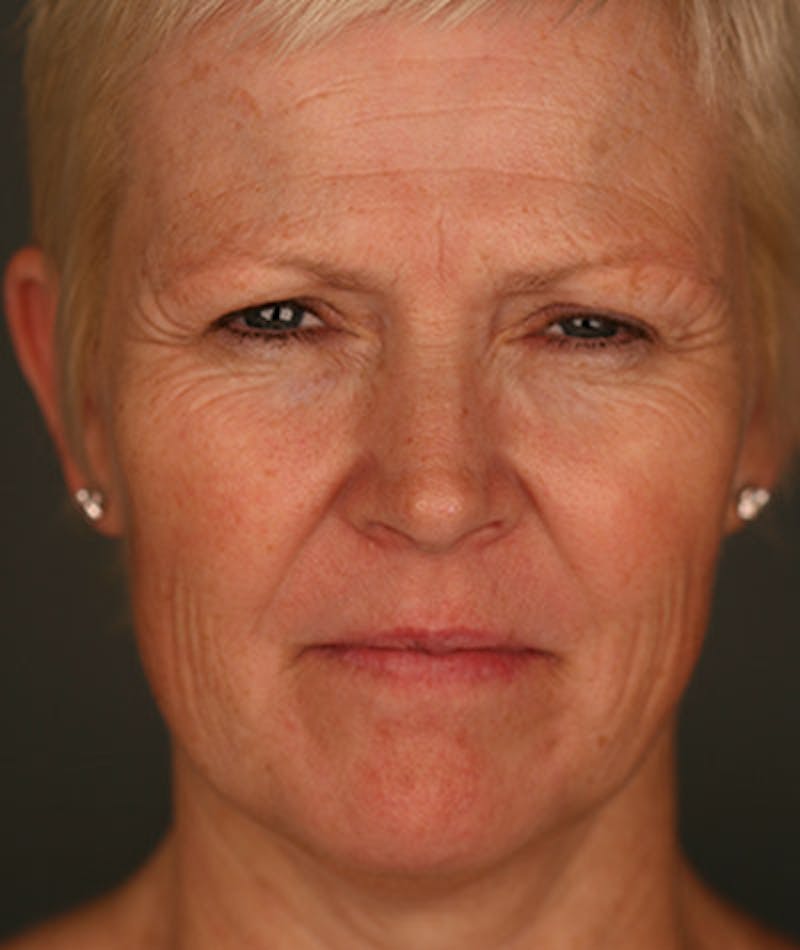 Facelift Before & After Gallery - Patient 108404111 - Image 5