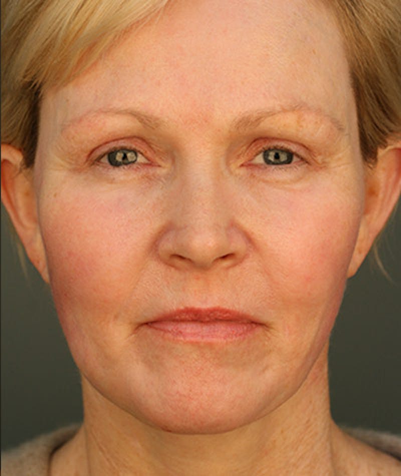 Facelift Before & After Gallery - Patient 108404111 - Image 4