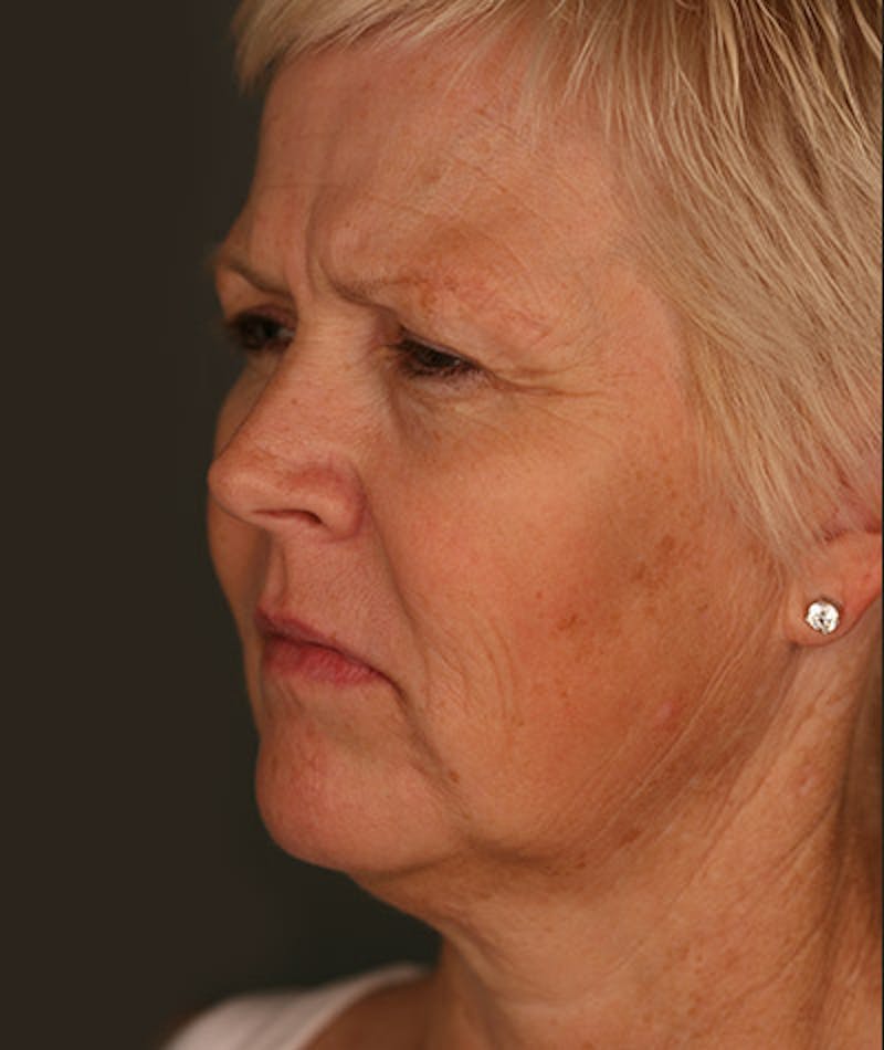 Facelift Before & After Gallery - Patient 108404111 - Image 1