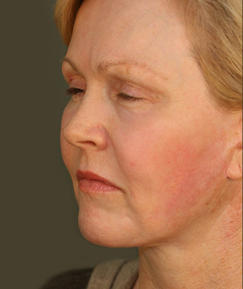 Facelift Before & After Gallery - Patient 108404111 - Image 6