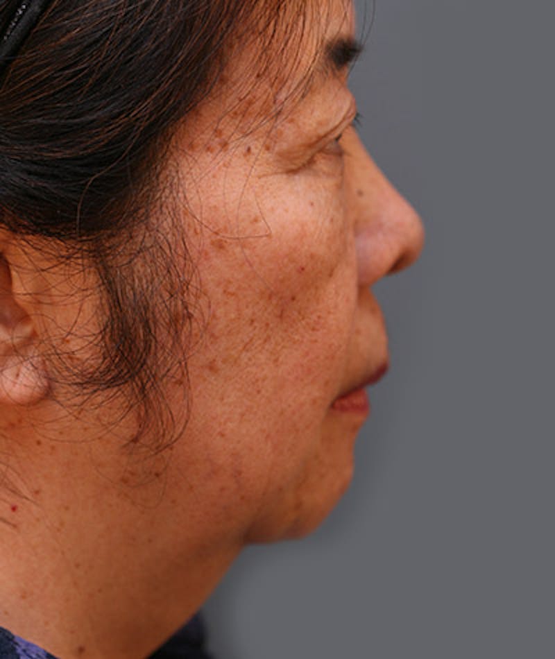 Facelift Before & After Gallery - Patient 108404193 - Image 3