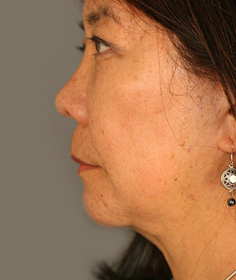 Facelift Before & After Gallery - Patient 108404193 - Image 4