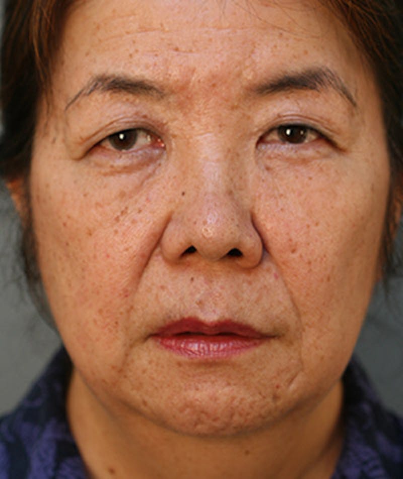 Facelift Before & After Gallery - Patient 108404193 - Image 5