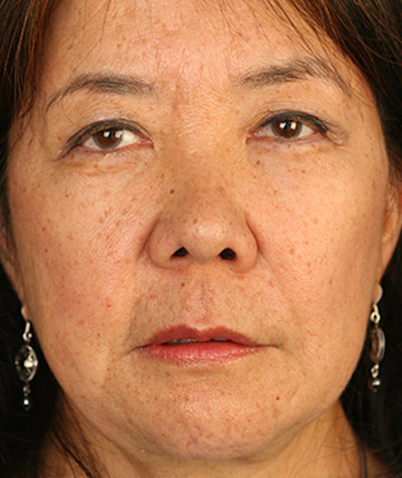 Facelift Before & After Gallery - Patient 108404193 - Image 6