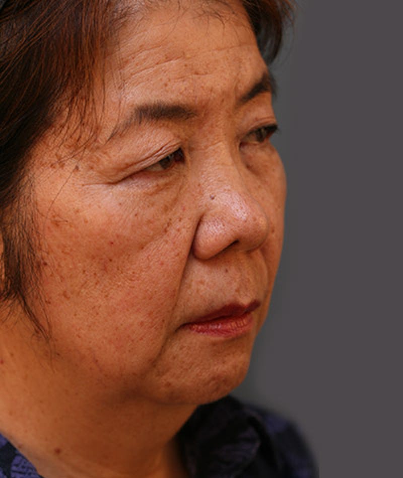 Facelift Before & After Gallery - Patient 108404193 - Image 1