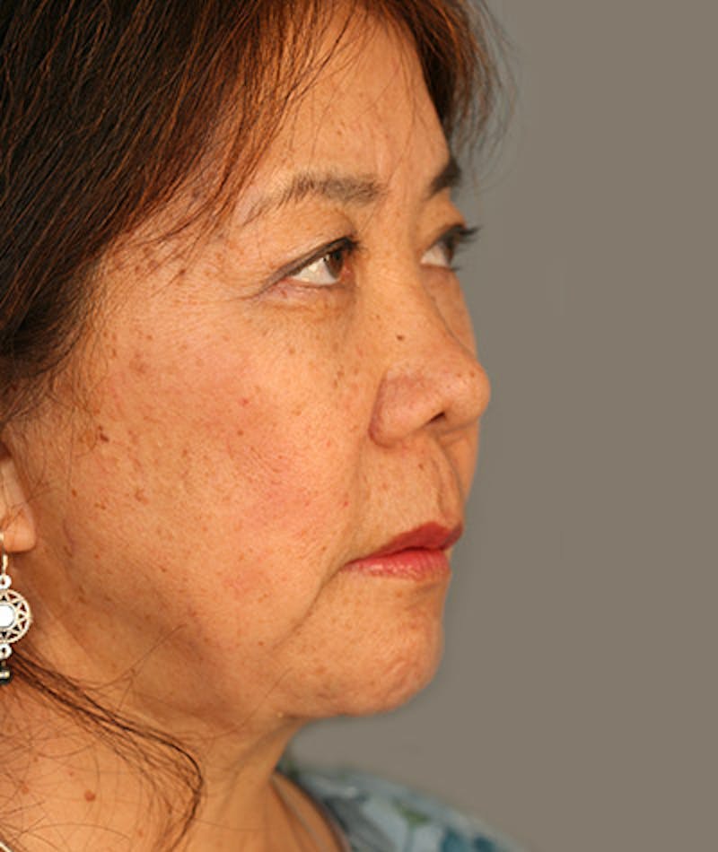 Facelift Before & After Gallery - Patient 108404193 - Image 6