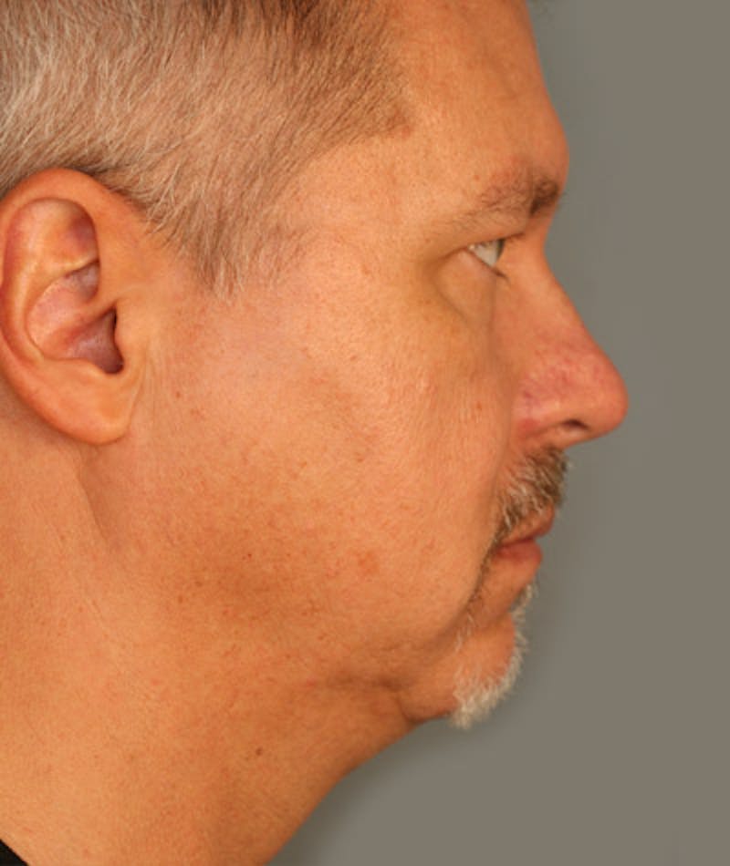 Facelift Before & After Gallery - Patient 108404243 - Image 3