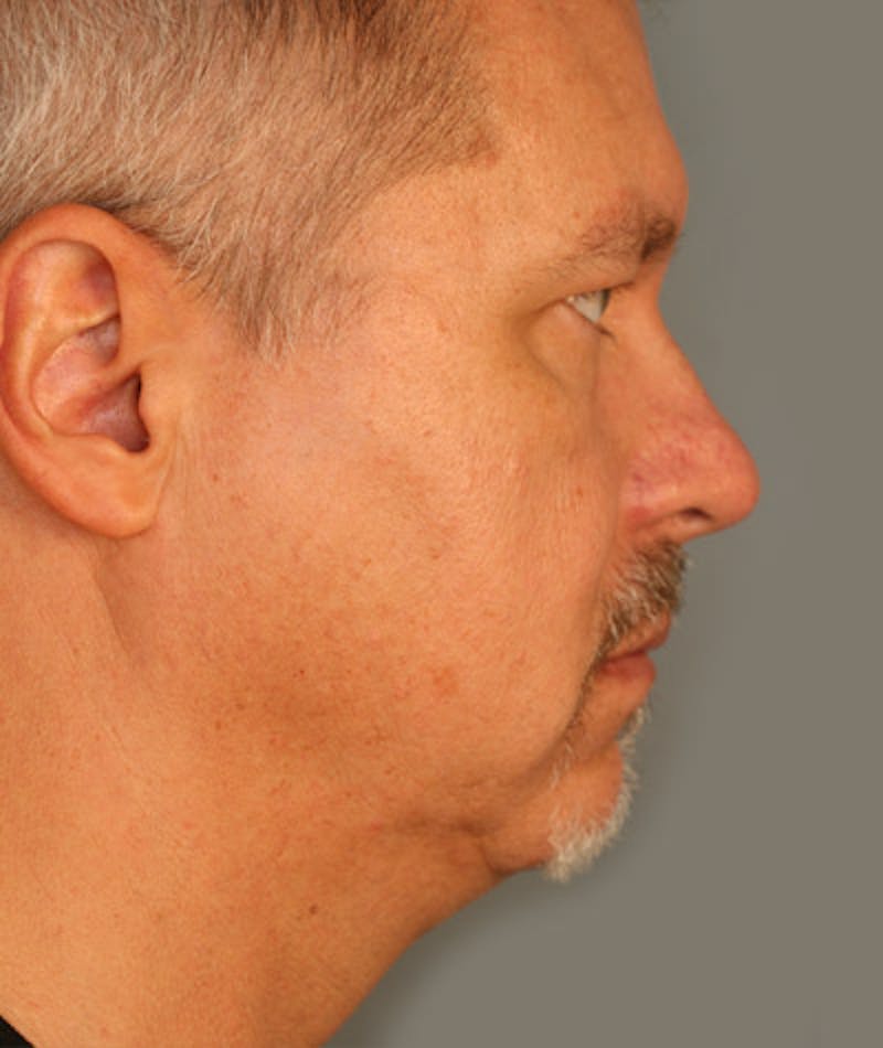 Facelift Before & After Gallery - Patient 108404243 - Image 3