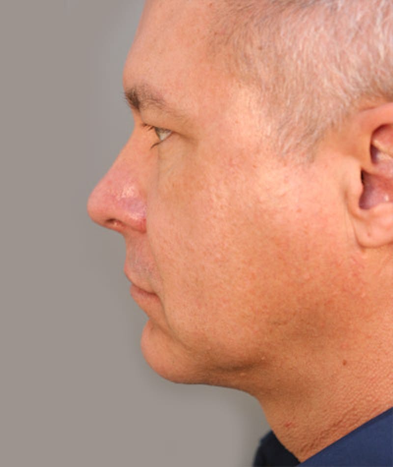 Facelift Before & After Gallery - Patient 108404243 - Image 4