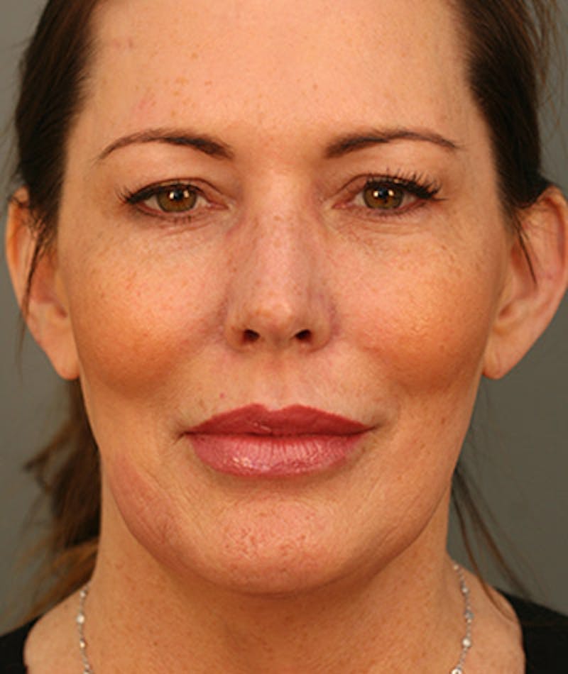 Facelift Before & After Gallery - Patient 108404291 - Image 3