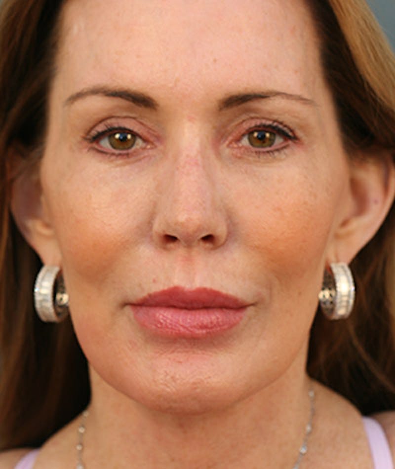 Facelift Before & After Gallery - Patient 108404291 - Image 6
