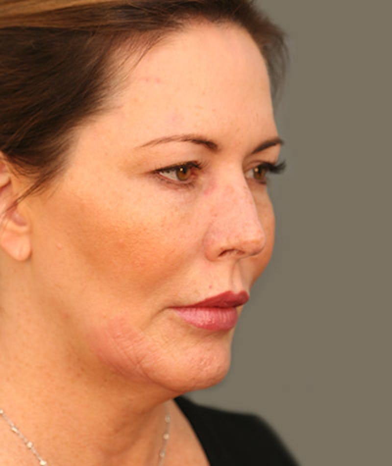 Facelift Before & After Gallery - Patient 108404291 - Image 1