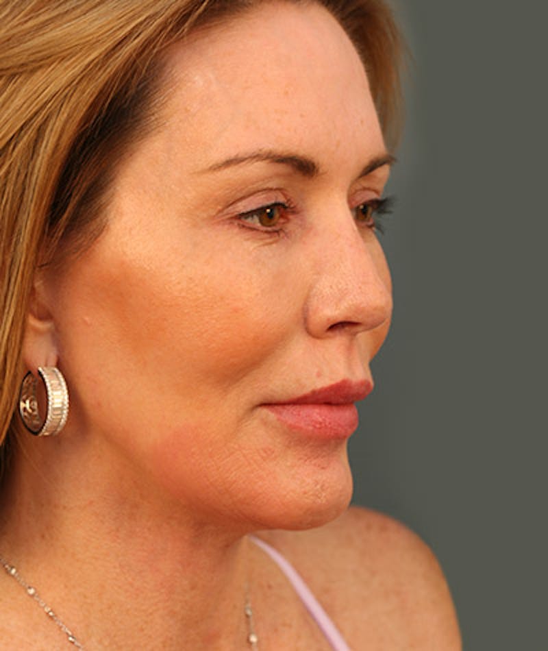 Facelift Before & After Gallery - Patient 108404291 - Image 2