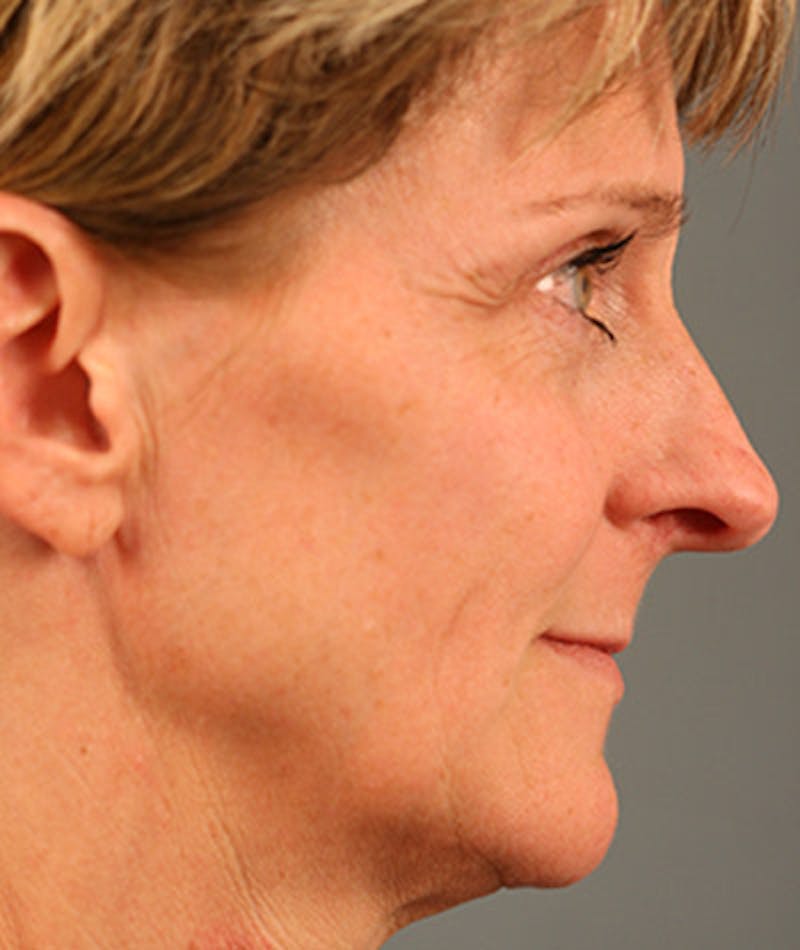 Facelift Before & After Gallery - Patient 108404346 - Image 3