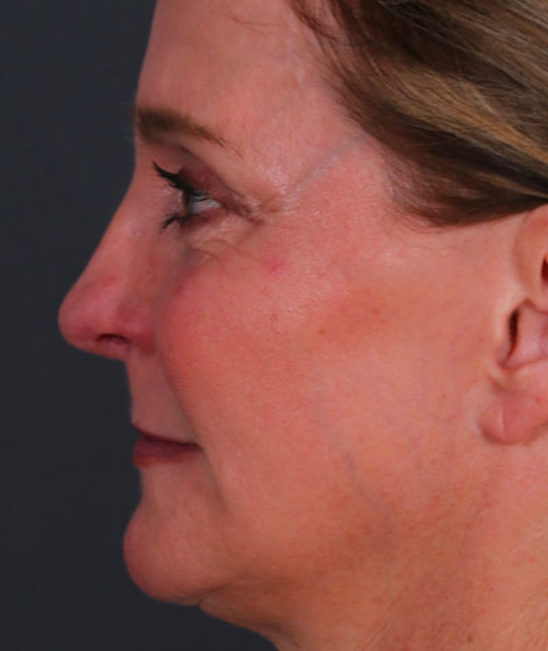Facelift Before & After Gallery - Patient 108404346 - Image 4