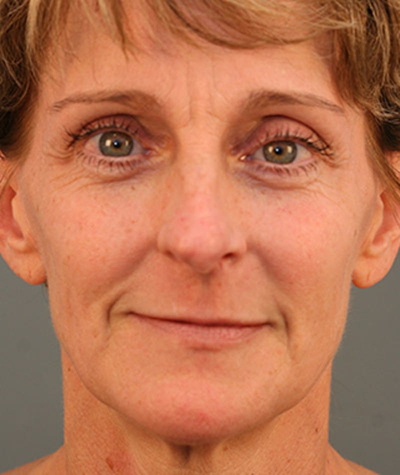 Facelift Before & After Gallery - Patient 108404346 - Image 5
